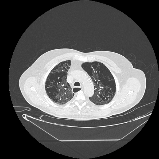 Cavitating bronchogenic carcinoma (Radiopaedia 44489-48162 Axial lung window 20).jpg
