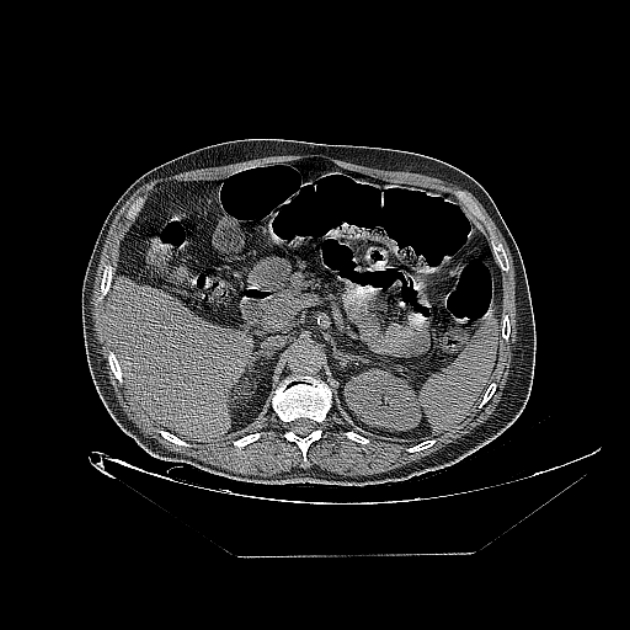 Cavitating bronchogenic carcinoma (Radiopaedia 44489-48162 Axial non-contrast 97).jpg
