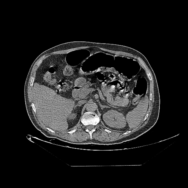Cavitating bronchogenic carcinoma (Radiopaedia 44489-48162 Axial non-contrast 98).jpg
