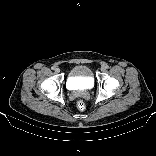 Cecal adenocarcinoma (Radiopaedia 85324-100916 Axial C+ delayed 95).jpg