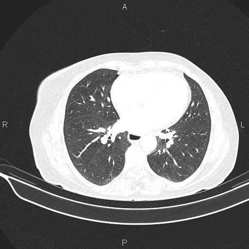 Cecal cancer (Radiopaedia 85610-101358 Axial lung window 40).jpg