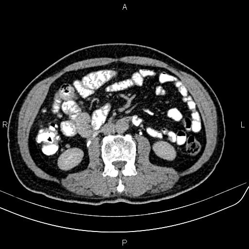 File:Cecal cancer with appendiceal mucocele (Radiopaedia 91080-108651 Axial C+ delayed 33).jpg