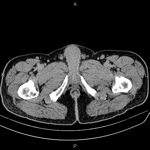 File:Cecal cancer with appendiceal mucocele (Radiopaedia 91080-108651 Axial C+ delayed 95).jpg
