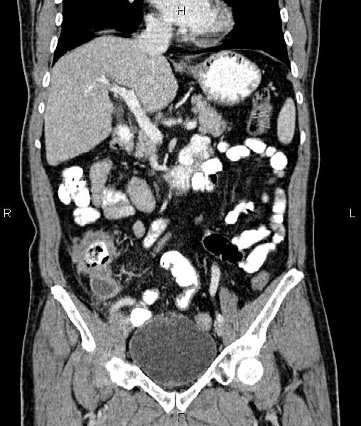 Cecal cancer with appendiceal mucocele (Radiopaedia 91080-108651 D 33).jpg