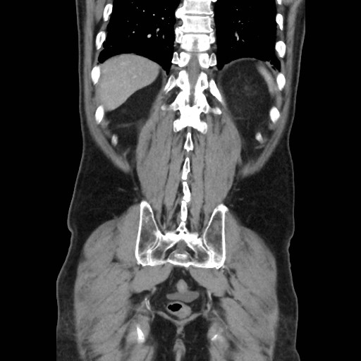 Cecal mass causing appendicitis (Radiopaedia 59207-66531 B 43).jpg