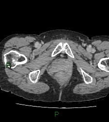 Cecal volvulus (Radiopaedia 86741-102900 A 140).jpg