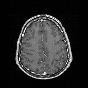 Central-variant posterior reversible encephalopathy syndrome (PRES) (Radiopaedia 43880-47358 Axial T1 C+ 127).jpg