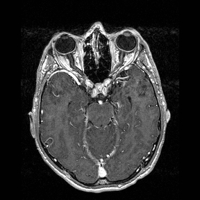 Central-variant posterior reversible encephalopathy syndrome (PRES) (Radiopaedia 43880-47358 Axial T1 C+ 55).jpg