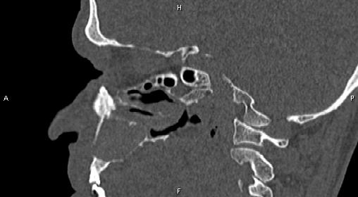File:Central giant cell granuloma (Radiopaedia 83346-97761 Sagittal bone window 20).jpg