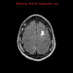 File:Central nervous system vasculitis (Radiopaedia 8410-9235 Axial FLAIR 21).jpg