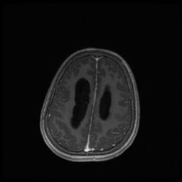 Central neurocytoma (Radiopaedia 30220-30842 Axial T1 C+ 113).jpg