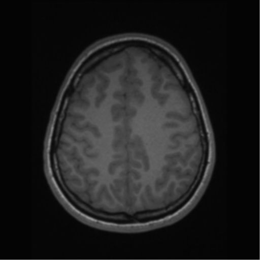 File:Central neurocytoma (Radiopaedia 37664-39557 Axial T1 57).png