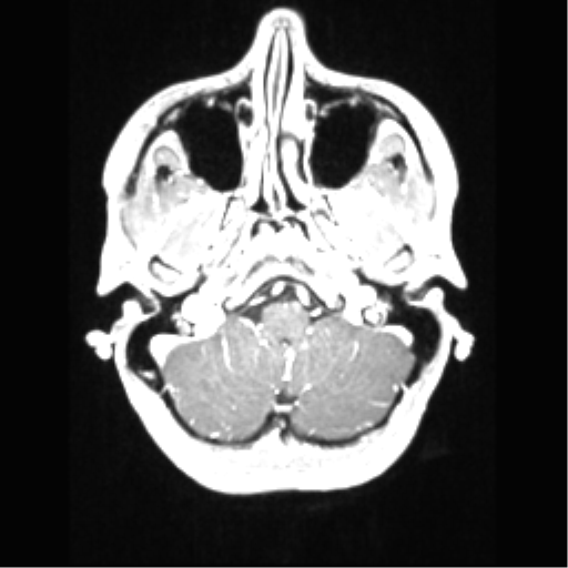 File:Central neurocytoma (Radiopaedia 37664-39557 Axial T1 C+ 15).png