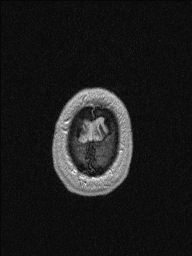 Central neurocytoma (Radiopaedia 56690-63469 Axial T1 C+ 156).jpg