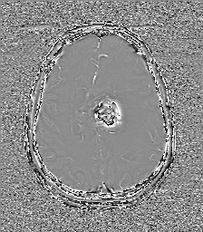 File:Central neurocytoma (Radiopaedia 84497-99872 Axial 49).jpg