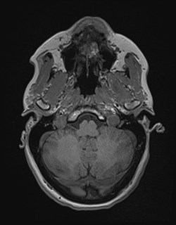 File:Central neurocytoma (Radiopaedia 84497-99872 Axial T1 46).jpg