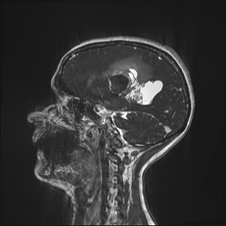 File:Central neurocytoma (Radiopaedia 84497-99872 Sagittal CISS 61).jpg
