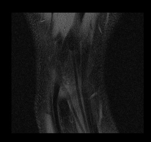 File:Central triangular fibrocartilage perforation (Radiopaedia 73346-84130 Coronal T1 fat sat 1).jpg