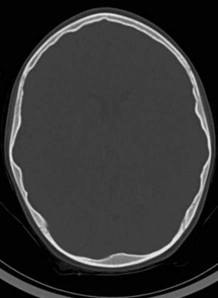 Cerebellar abscess (Radiopaedia 73727-84527 Axial bone window 39).jpg