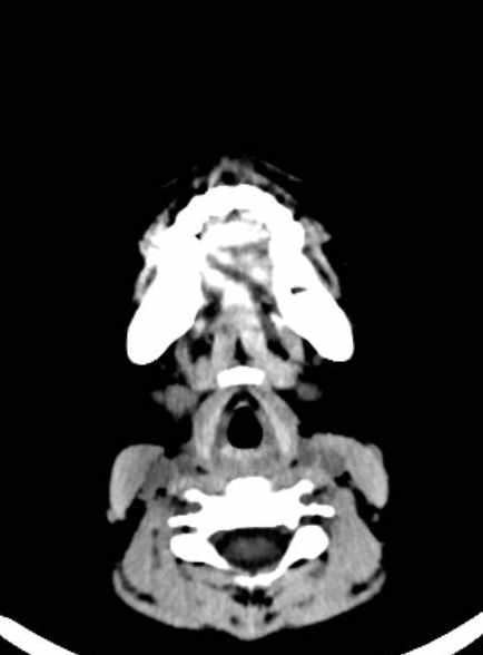 Cerebellar abscess (Radiopaedia 73727-84527 Axial non-contrast 2).jpg