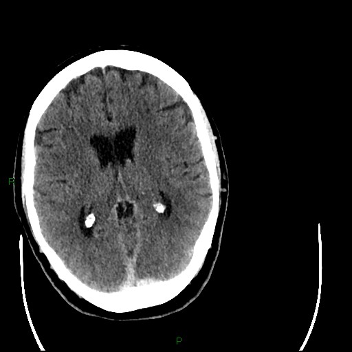 Cerebellar abscess (Radiopaedia 78135-90671 Axial C+ delayed 59).jpg