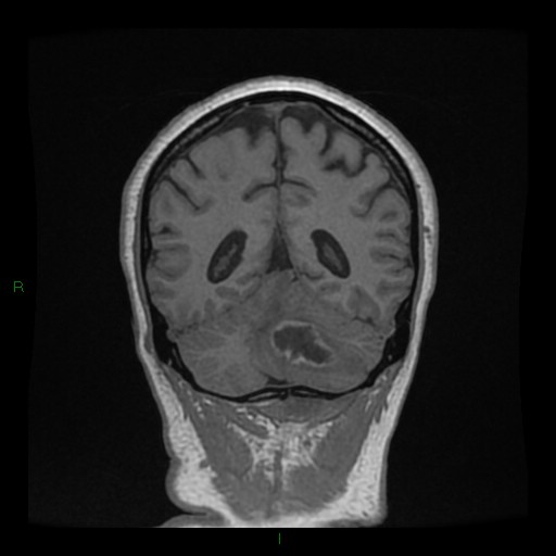 File:Cerebellar abscess (Radiopaedia 78135-90678 Coronal T1 C+ 118).jpg
