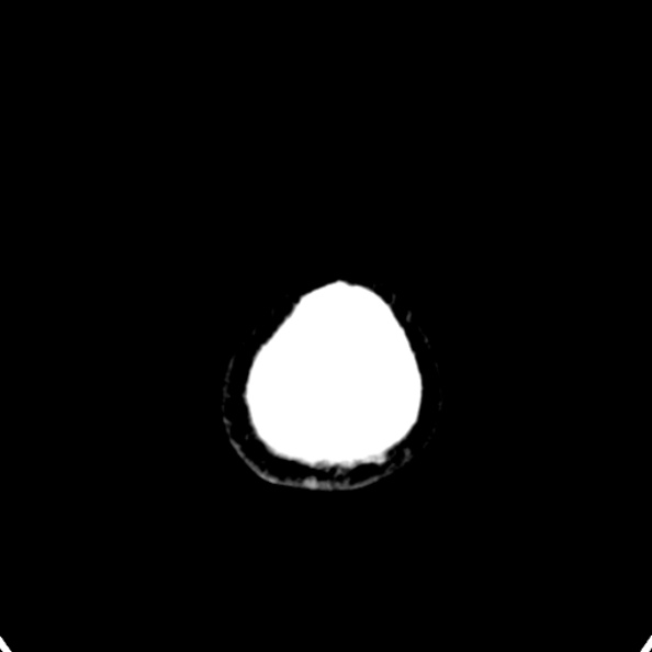 Cerebellar abscess secondary to mastoiditis (Radiopaedia 26284-26412 Axial non-contrast 156).jpg