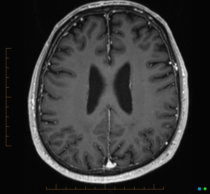 Cerebellar gangliocytoma (Radiopaedia 65377-74422 Axial T1 C+ 90).jpg