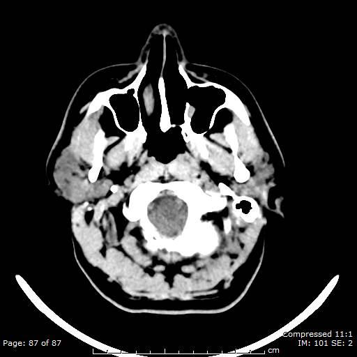 Cerebellar hemangioblastoma (Radiopaedia 52360-58258 Axial non-contrast 87).jpg