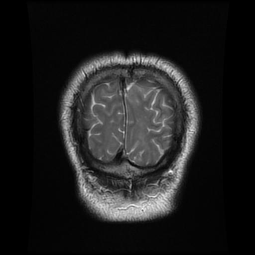File:Cerebellar hemangioblastoma (Radiopaedia 88055-104622 Coronal T2 18).jpg