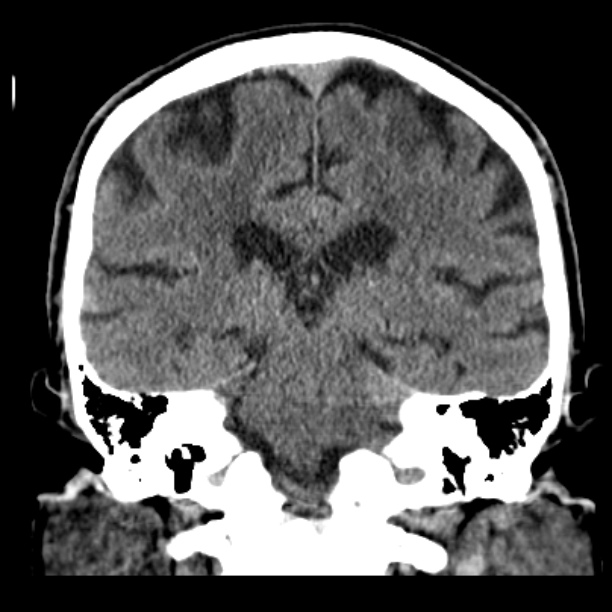 Cerebellar hemorrhage (Radiopaedia 27193-27359 Coronal non-contrast 35).jpg