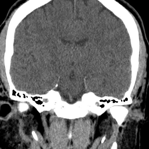 Cerebellar infarction (Radiopaedia 16625-16327 Coronal non-contrast 9).jpg