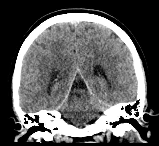 File:Cerebellar metastases - colorectal adenocarcinoma (Radiopaedia 40947-43652 Coronal non-contrast 61).png