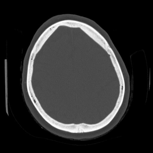Cerebellar metastasis (cystic appearance) (Radiopaedia 41395-44258 Axial bone window 53).png