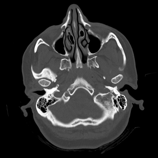 Cerebellar metastasis (cystic appearance) (Radiopaedia 41395-44258 Axial bone window 8).png