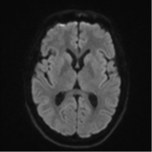 Cerebellar metastasis - adenocarcinoma lung (Radiopaedia 63184-71715 Axial DWI 44).png
