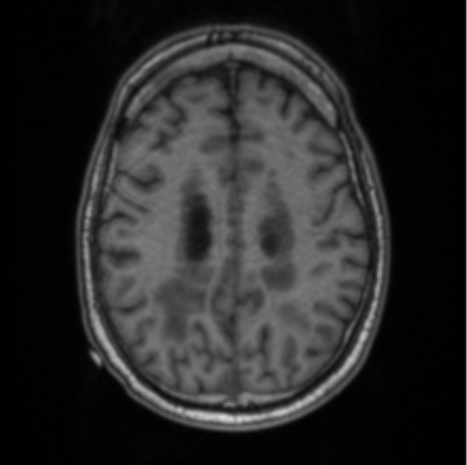 Cerebellar metastasis from lung adenocarcinoma (Radiopaedia 86690-102829 Axial T1 58).png