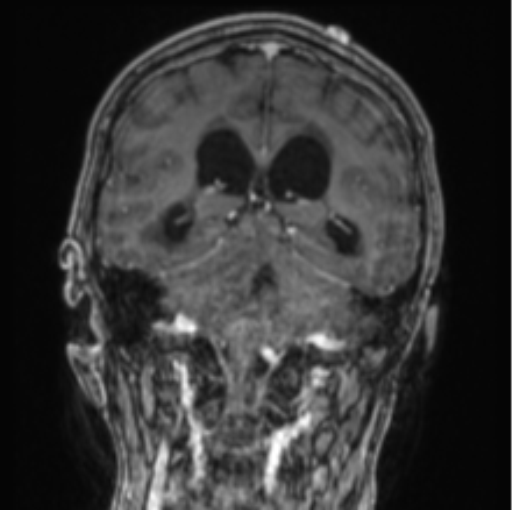 Cerebellar metastasis from lung adenocarcinoma (Radiopaedia 86690-102829 Coronal T1 C+ 43).png
