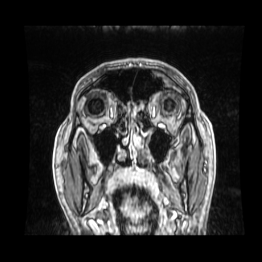 Cerebellar metastasis of pulmonary adenocarcinoma, cavernous venous malformation, and developmental venous anomaly (Radiopaedia 85827-101661 Coronal T1 C+ 82).jpg
