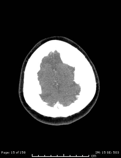 File:Cerebellar strokes due to intracranial giant cell arteritis (Radiopaedia 68799-78510 CT angiogram 15).jpg