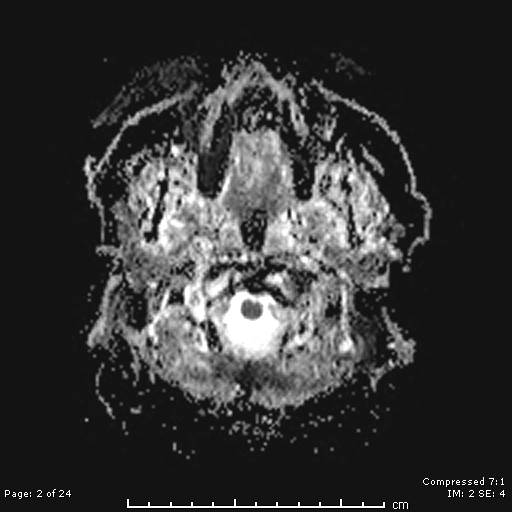 File:Cerebellar strokes due to intracranial giant cell arteritis (Radiopaedia 68799-81713 Axial ADC 2).jpg