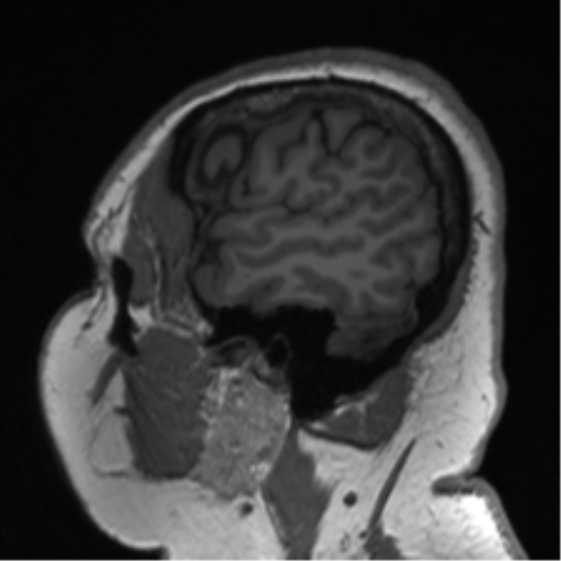 Cerebellopontine angle meningioma (Radiopaedia 48434-53348 Sagittal T1 18).png