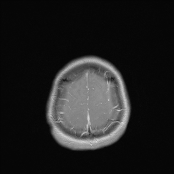 Cerebral abscess (Radiopaedia 24212-24478 Axial T1 C+ 52).jpg