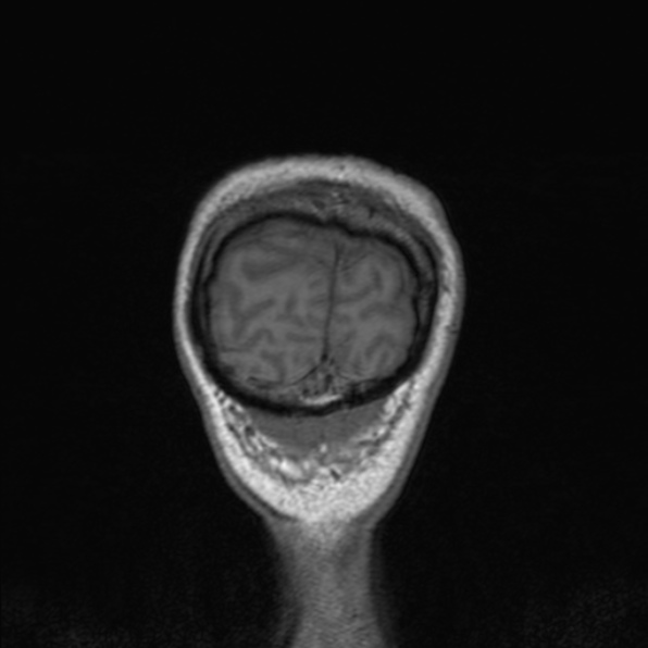 Cerebral abscess (Radiopaedia 24212-24478 Coronal T1 184).jpg