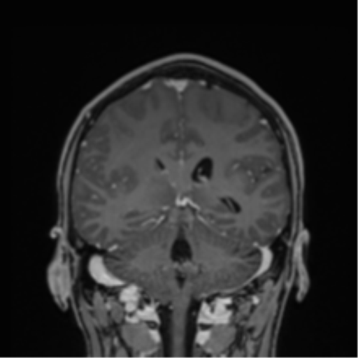 File:Cerebral abscess (Radiopaedia 60342-68009 H 17).png
