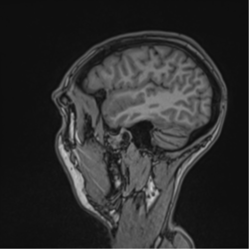 File:Cerebral abscess (Radiopaedia 60342-68009 Sagittal T1 14).png