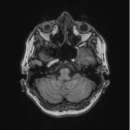 Cerebral abscess from pulmonary arteriovenous malformation (Radiopaedia 86275-102291 Axial T1 18).png