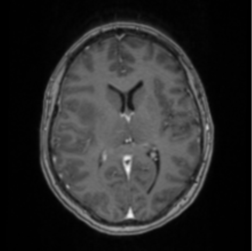 Cerebral abscess from pulmonary arteriovenous malformation (Radiopaedia 86275-102291 Axial T1 C+ 42).png