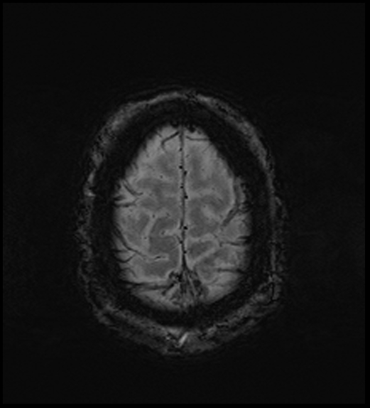 Cerebral abscess with ventriculitis (Radiopaedia 78965-91878 Axial SWI 47).jpg