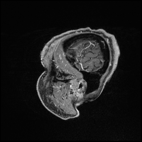 Cerebral abscess with ventriculitis (Radiopaedia 78965-91878 Sagittal T1 C+ 21).jpg